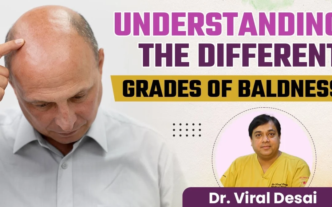 Stages of Baldness by Dr. Viral Desai
