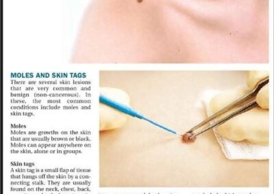 Dr Viral Desai on moles and skin tags