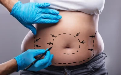 5 Myths and Facts About Liposuction