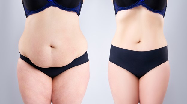 Cost of tummy tuck in Mumbai