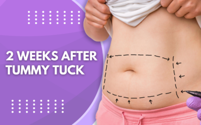 2 Weeks After Tummy Tuck