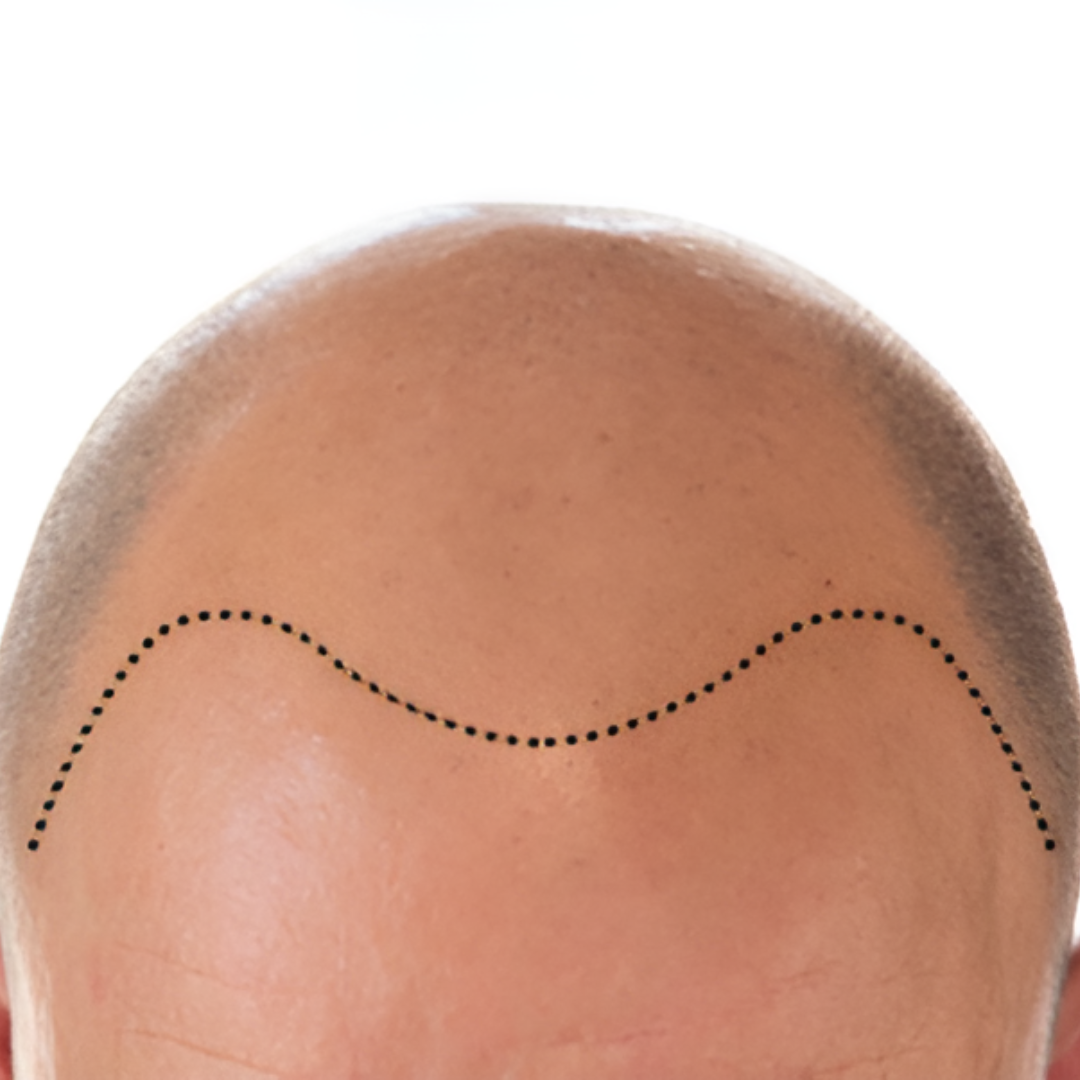 Ideal for Larger Bald Areas 