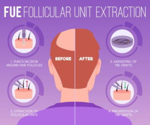 Follicle Extraction 