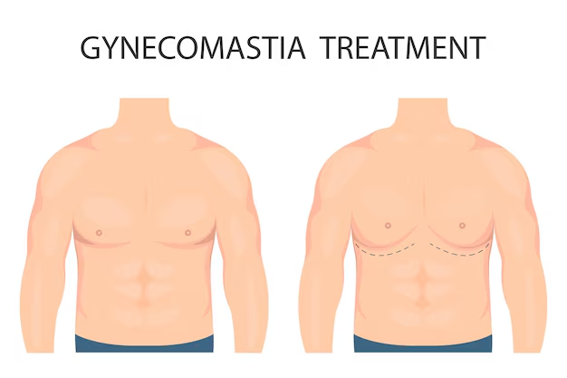 male breast reduction