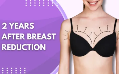 2 Years After Breast Reduction: What to Expect