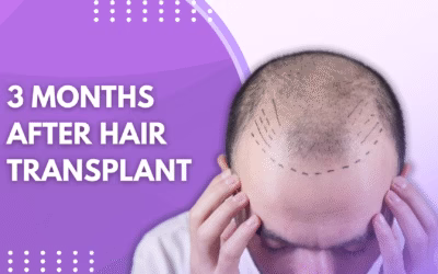 3 Months After Hair Transplant
