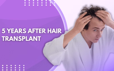 5 Years After Hair Transplant