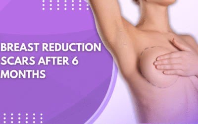 Breast Reduction Scars After 6 Months