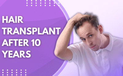 Hair Transplant After 10 Years