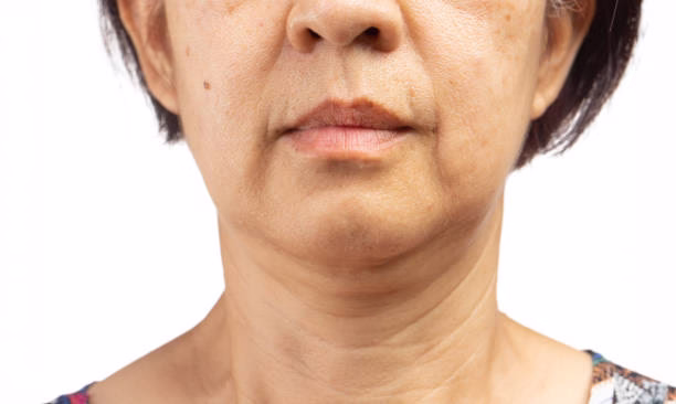 Who is an Ideal Candidate for EndoLift?