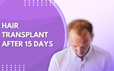 Hair Transplant After 15 Days