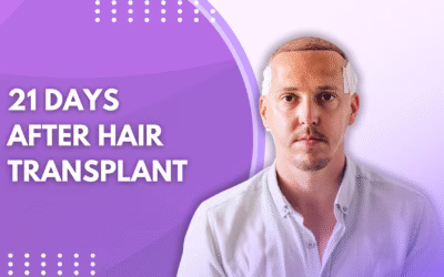 21 Days After Hair Transplant