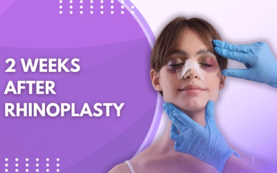 2 Weeks After Rhinoplasty