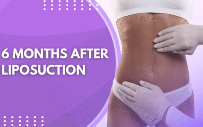 6 Months After Liposuction
