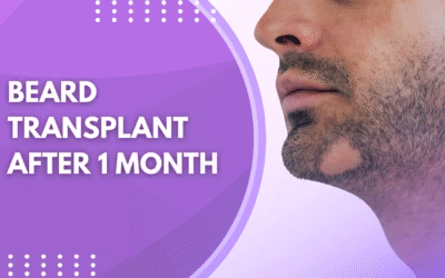 Beard Transplant After 1 Month