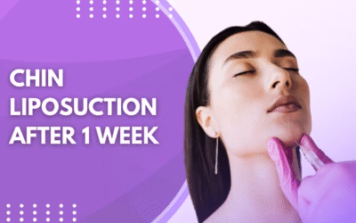 Chin Liposuction After 1 Week
