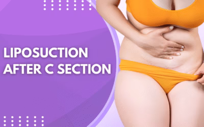 Liposuction After C Section