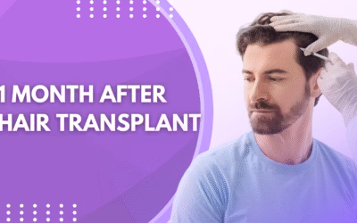 1 Month After Hair Transplant