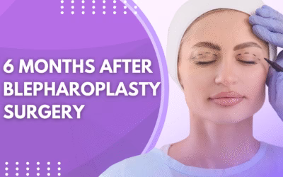 6 Months After Blepharoplasty Surgery