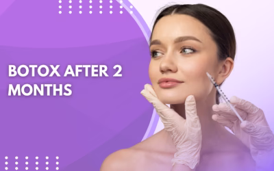 Botox After 2 Months