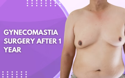 Gynecomastia Surgery After 1 Year