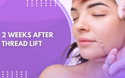 2 Weeks After Thread Lift