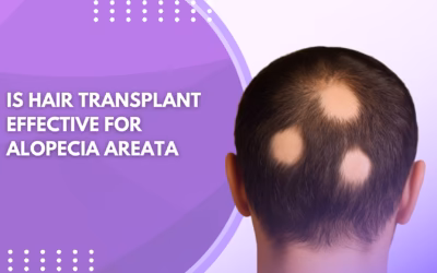 Is Hair Transplant Effective for Alopecia Areata ?