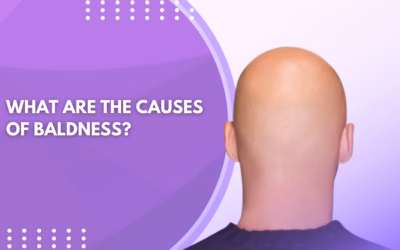 What Are the Causes of Baldness?