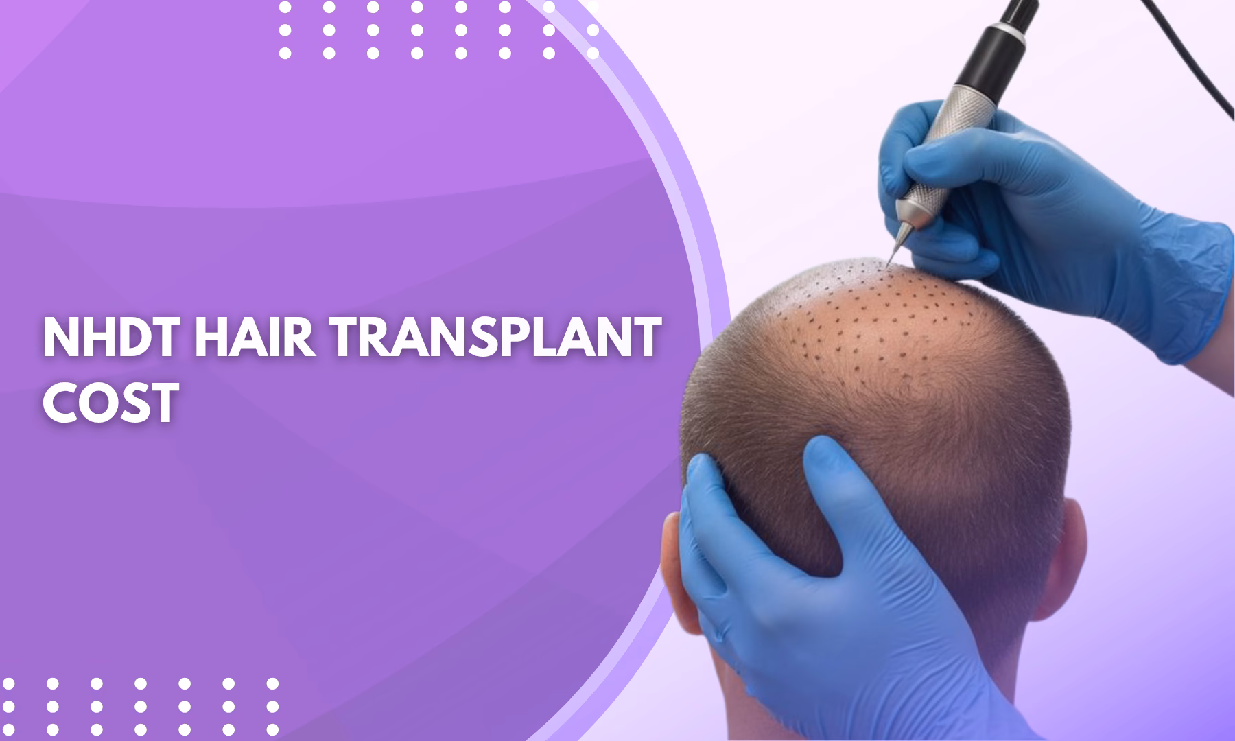 NHDT Hair Transplant Cost