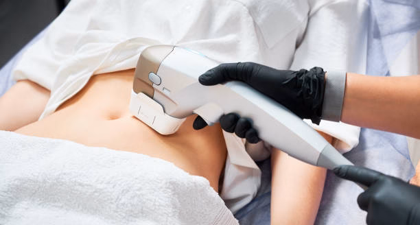 Picture Cosmetic procedure: gloved clinician uses a handheld device on a patient’s bare abdomen under a sheet.