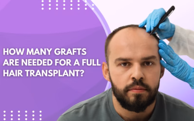 How Many Grafts Are Needed for a Full Hair Transplant?