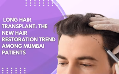 Long Hair Transplant: The New Hair Restoration Trend Among Mumbai Patients