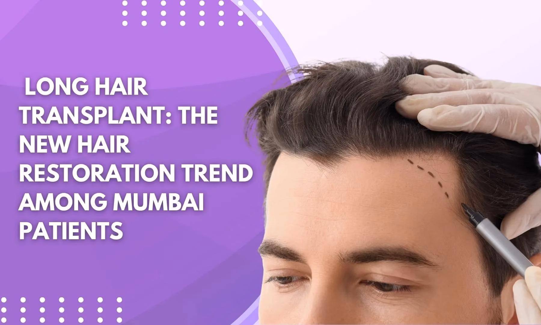 Is Robotic Hair Transplant Better Than Manual NHDT Method?