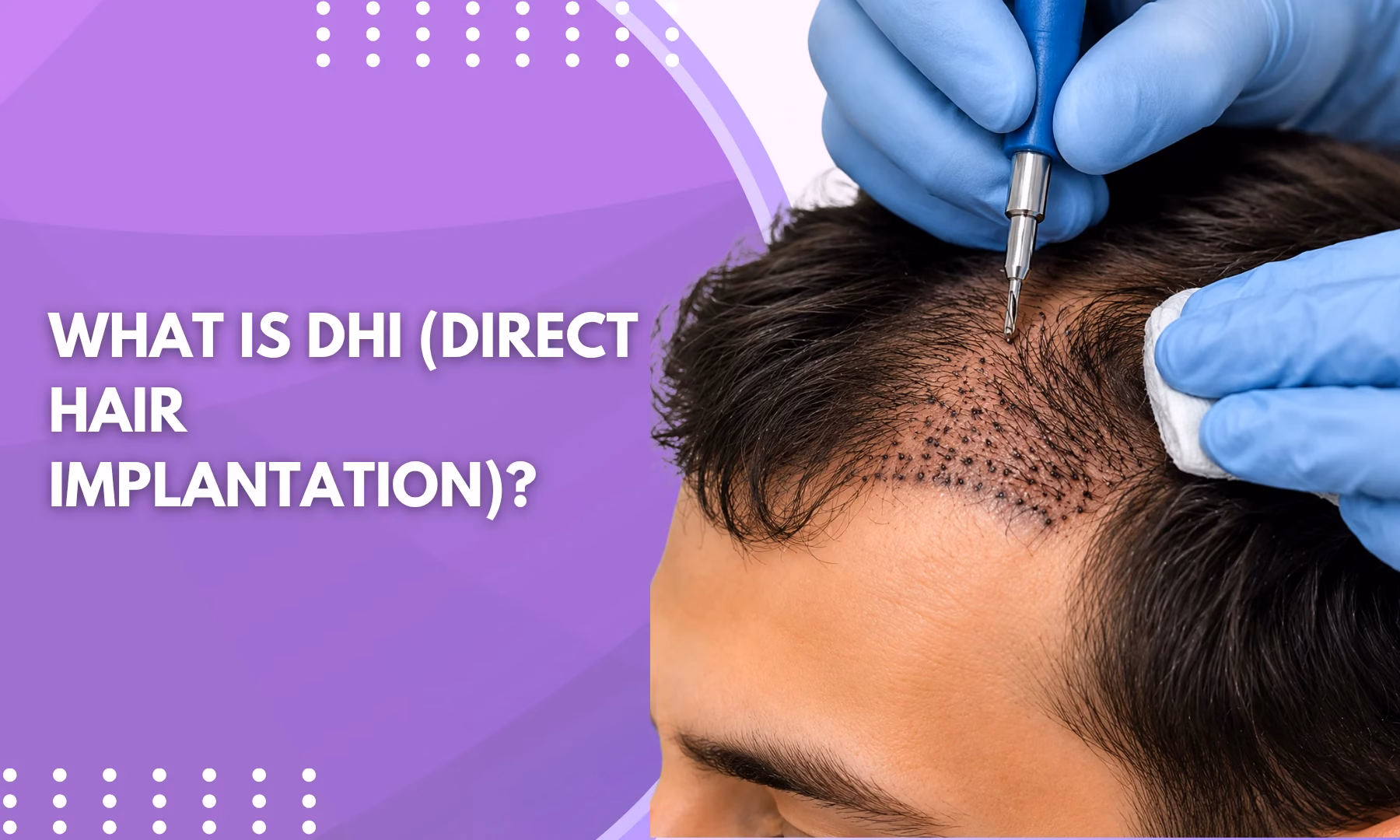 What is dhi direct hair implantation