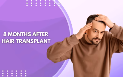 8 Months After Hair Transplant: What Results Should You Expect?