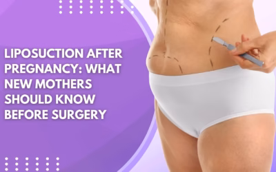 Liposuction After Pregnancy: What New Mothers Should Know Before Surgery