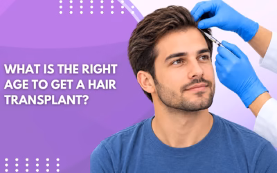 What Is the Right Age to Get a Hair Transplant?
