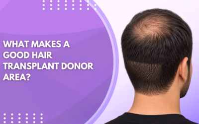 What Makes a Good Hair Transplant Donor Area?