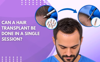 Can a Hair Transplant Be Done in a Single Session?