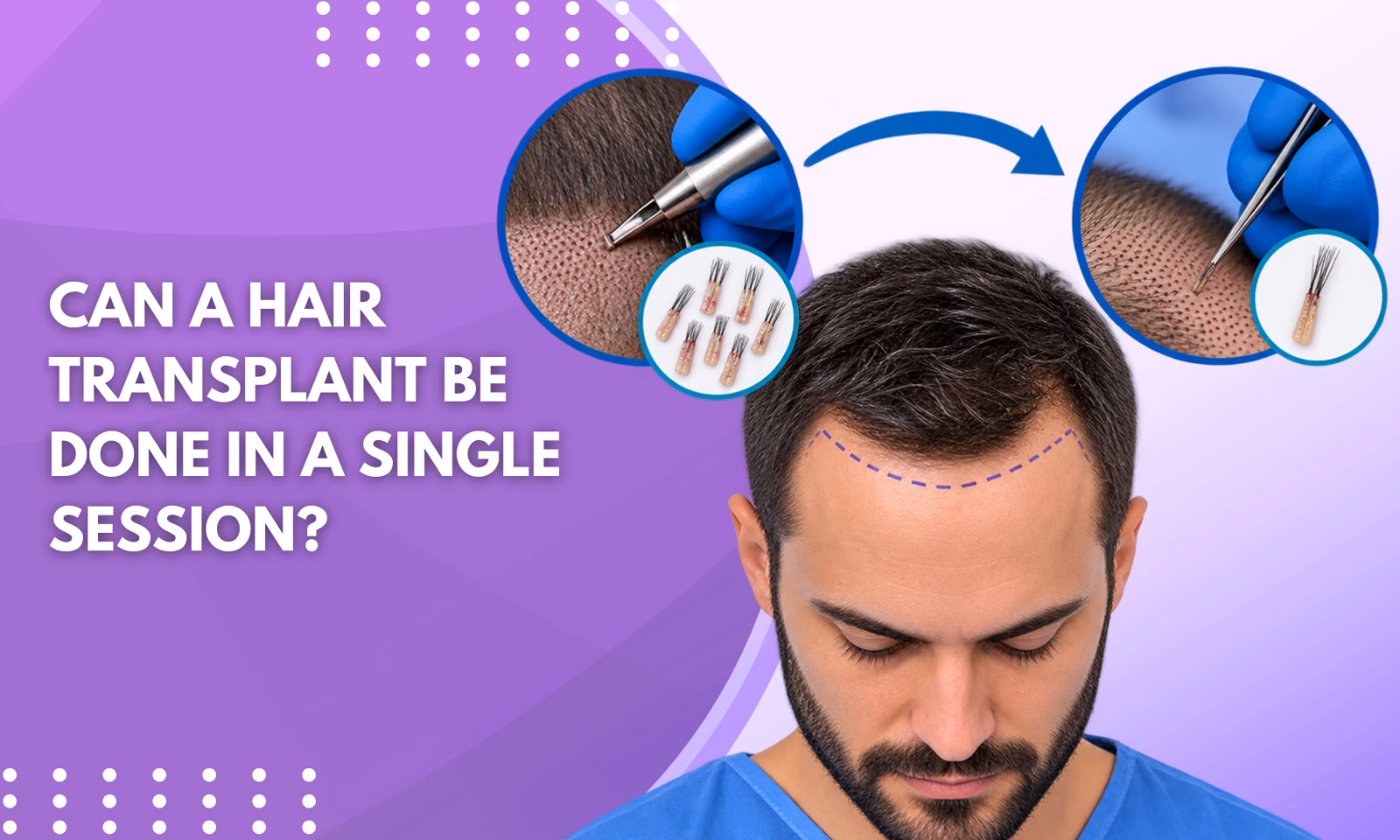 Can a Hair Transplant Be Done in a Single Session
